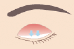 手術・治療 眼瞼下垂